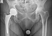 Röntgenbild Hüftprothese bei starker Hüftärthrose